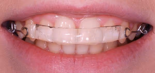 Inman Aligner in your mouth