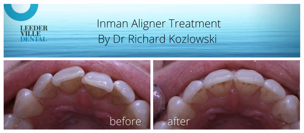 inman aligner perth dentist