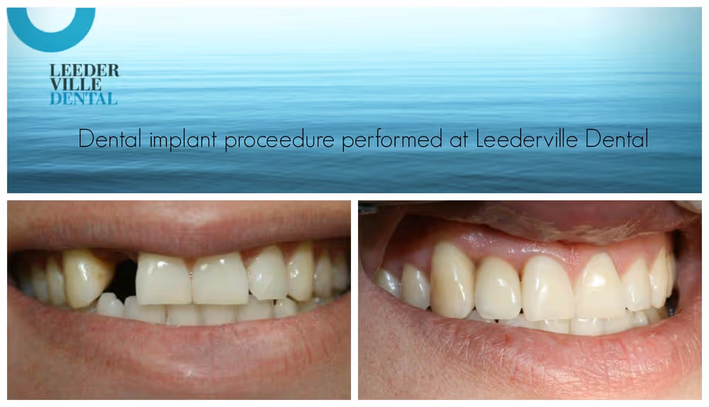 replace missing tooth
