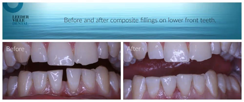 Closing gaps between lower front Teeth using composite fillings