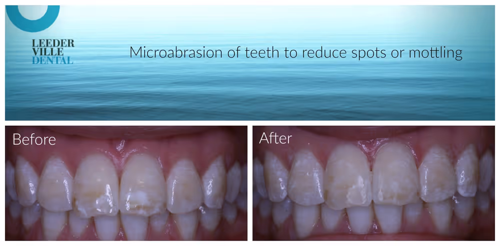 spots can be removed from teeth using microabrasion