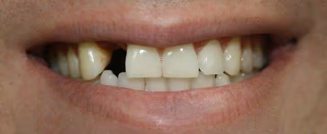 tooth implant