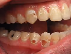 tooth decay from sugary drinks