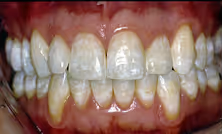 Dental fluorosis white marks on surface of teeth
