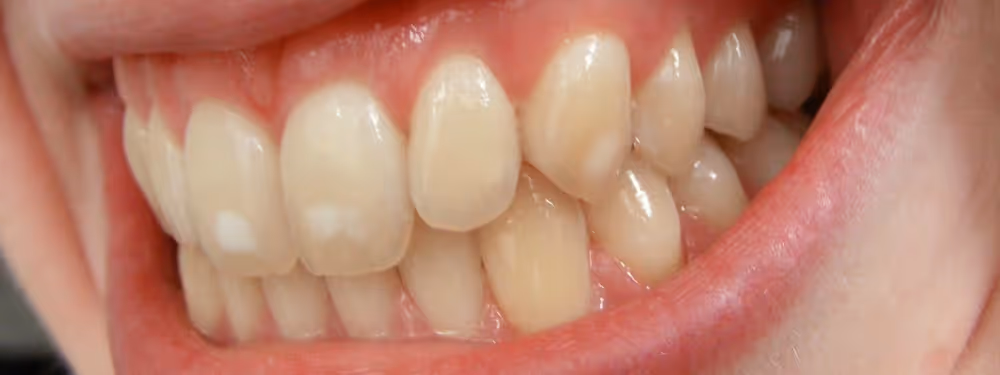 Fluorosis on teeth