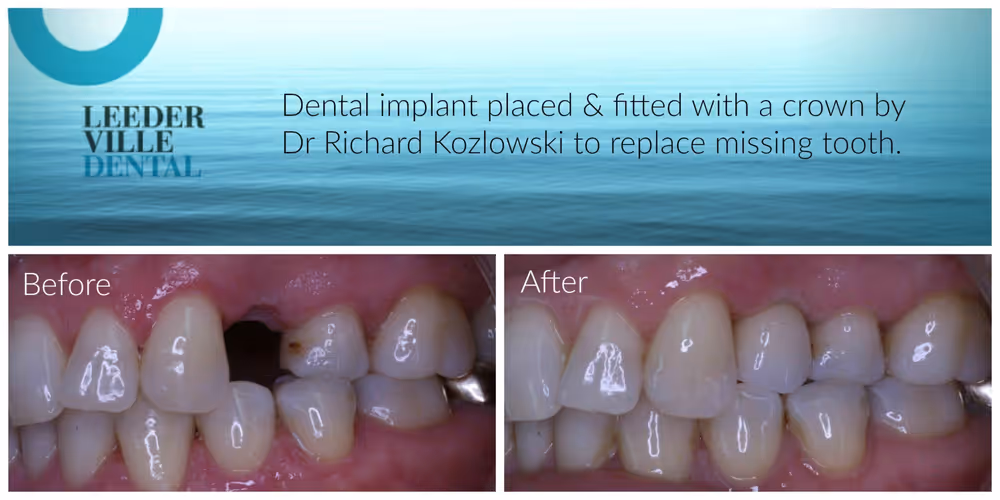 replacement of tooth
