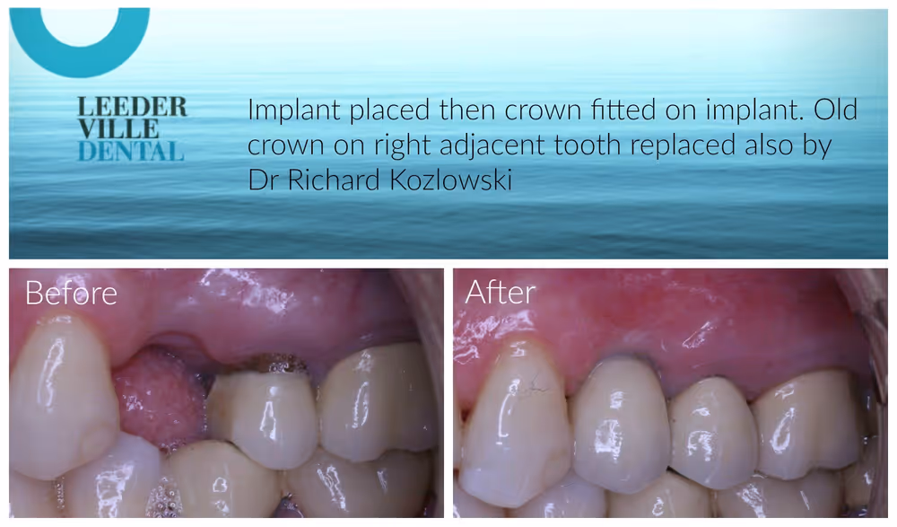 dental implant replaces missing tooth