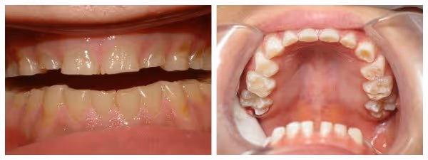 effects of teeth grinding