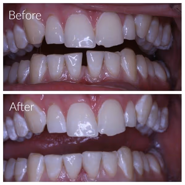 Composite fillings have been used to close gap between lower front teeth