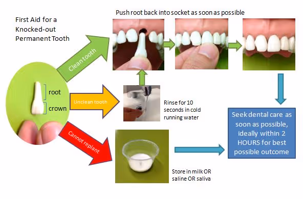 First aid for knocked out permanent teeth