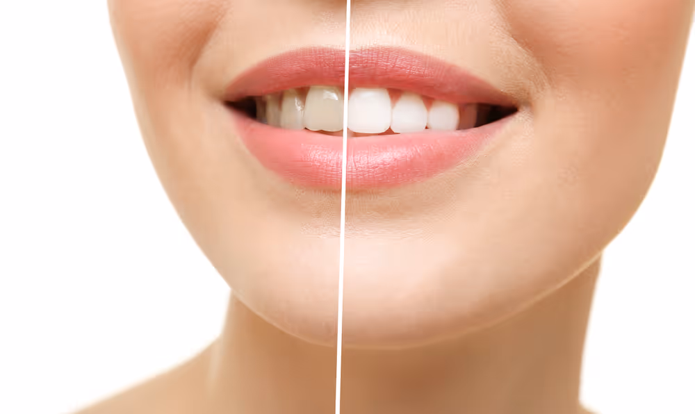 how expensive is teeth whitening