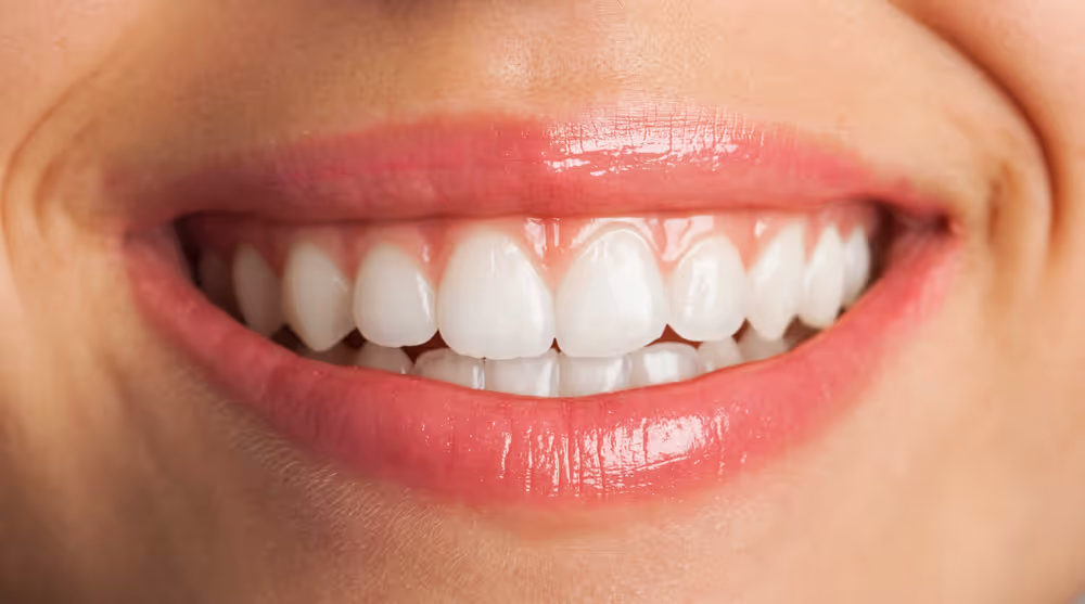 How Long Does Teeth Whitening Last