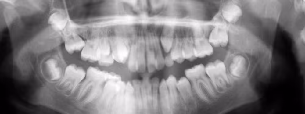 impacted wisdom teeth on teenager