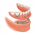 Implant supported denture