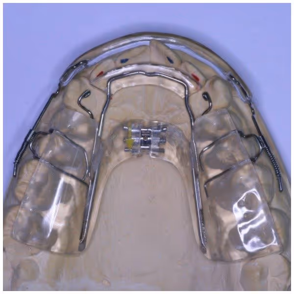 Inman Aligner on teeth mould