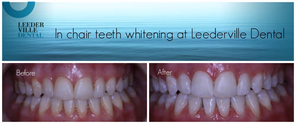 whiter teeth by dentist in perth
