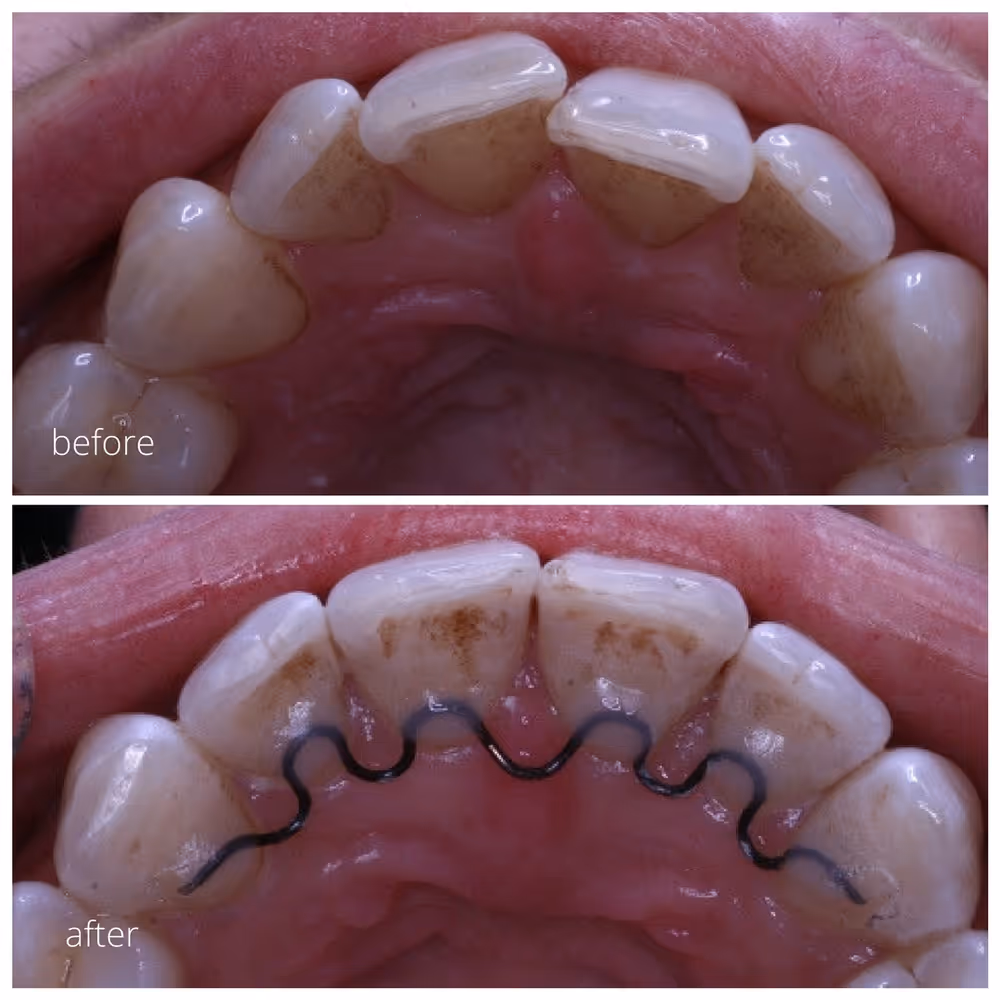 inman aligner results