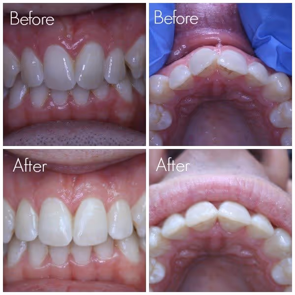 after wearing Inman Aligner on teeth
