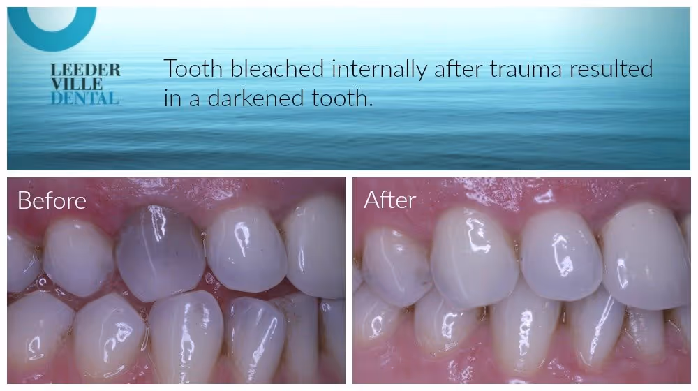 internal tooth bleached