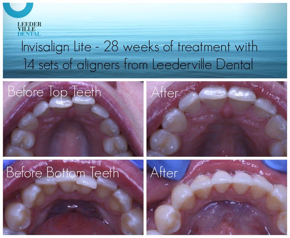 Invisalign Lite