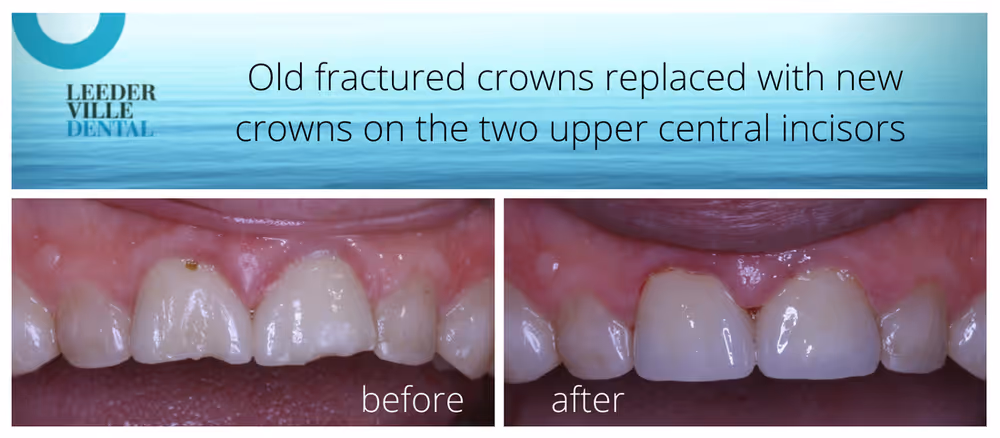 replace old tooth crowns