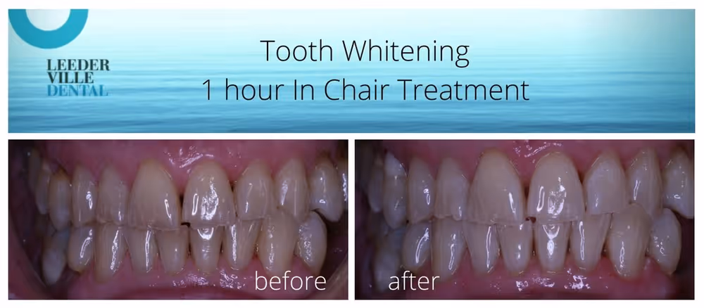 tooth whitening for elderly patient