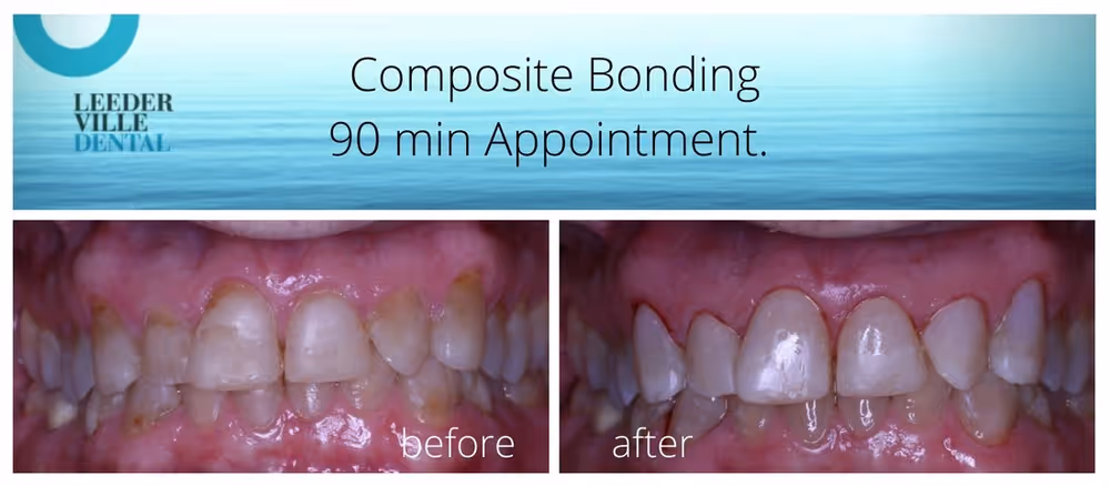 Composite bonding to improve teeth appearance