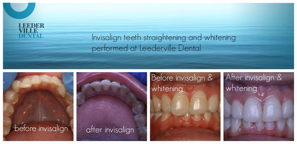 Should I whiten my teeth?: photo 2 at Leederville Dental, Mt Hawthorn