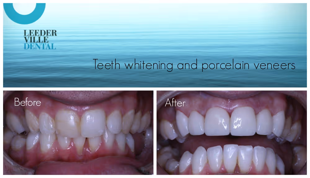Teeth Whitening: photo 20 at Leederville Dental, Mt Hawthorn