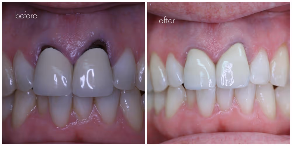 Dental Crowns: photo 8 at Leederville Dental, Mt Hawthorn