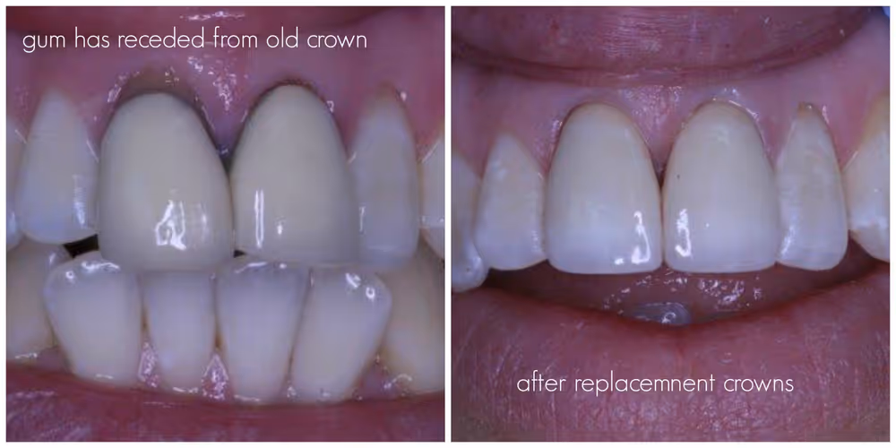 Dental Crowns: photo 15 at Leederville Dental, Mt Hawthorn