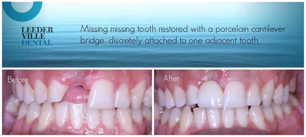 missing tooth replaced