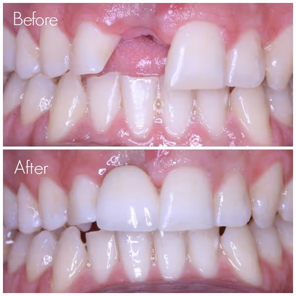 replace missing tooth