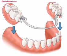 partial dentures