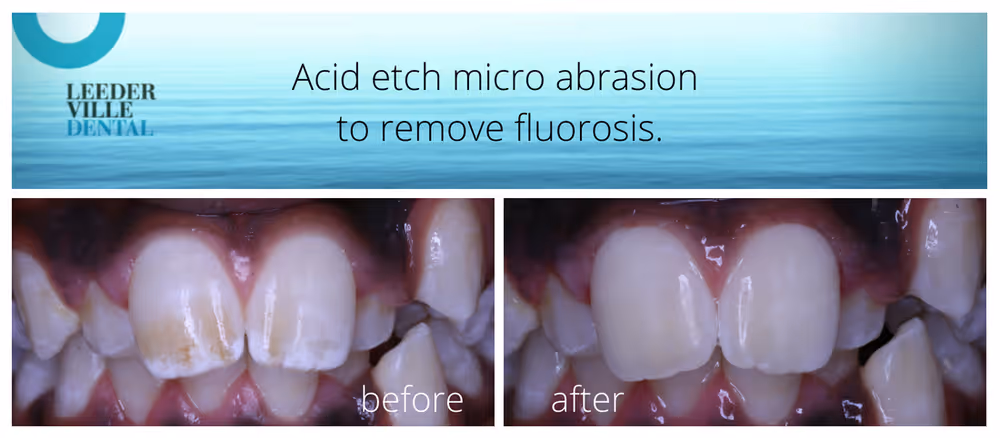 removal of dental fluorosis