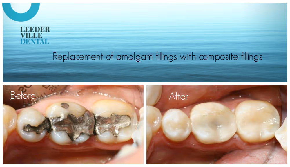 replace silver fillings