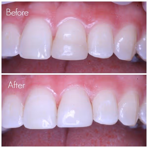 tooth repair with replacement filling