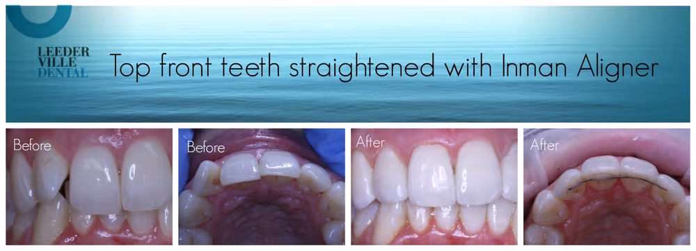 straighten front teeth with inman aligner