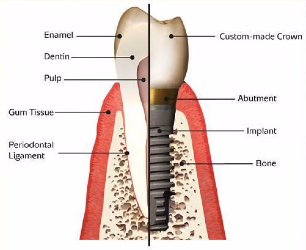 titanium implant with zirconium crown
