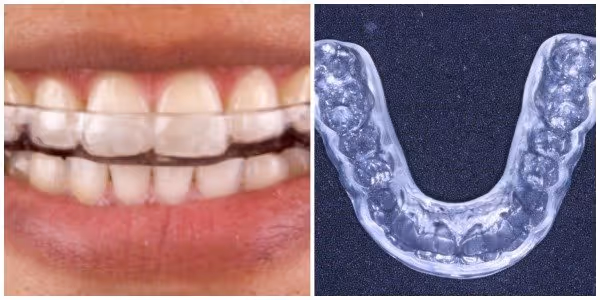 teeth gringding guard