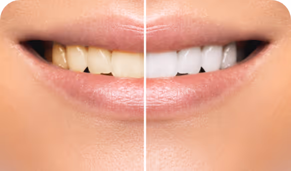 Teeth Whitening Leederville Dental