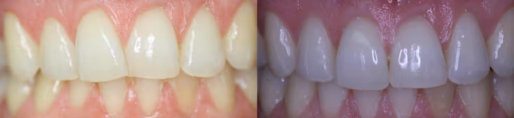 Dentist teeth whitening in Perth