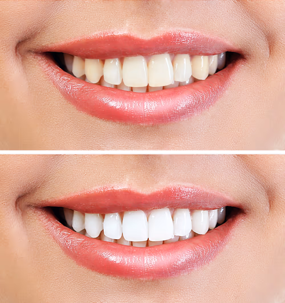 teeth whitening before and after