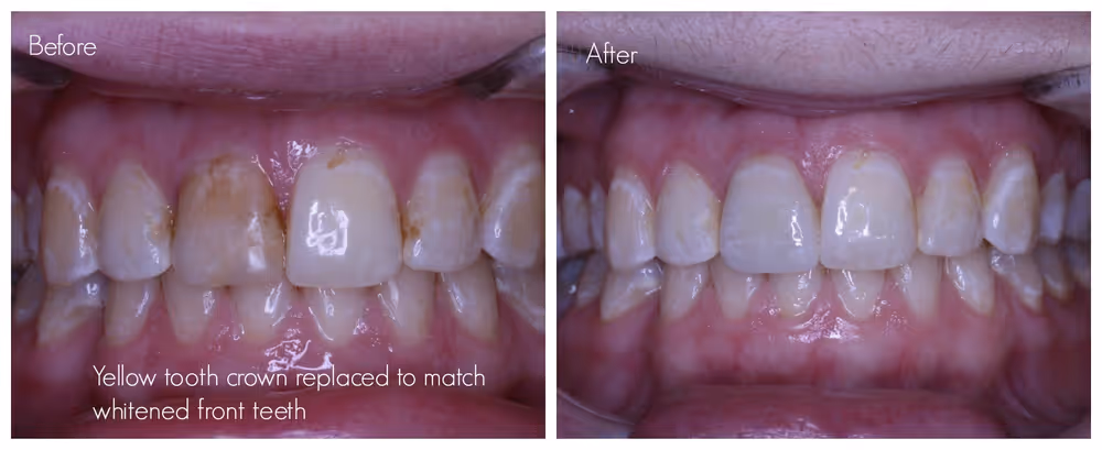 Tooth crown replacement as the colour of tooth crown no longer matches the colour of adjacent teeth