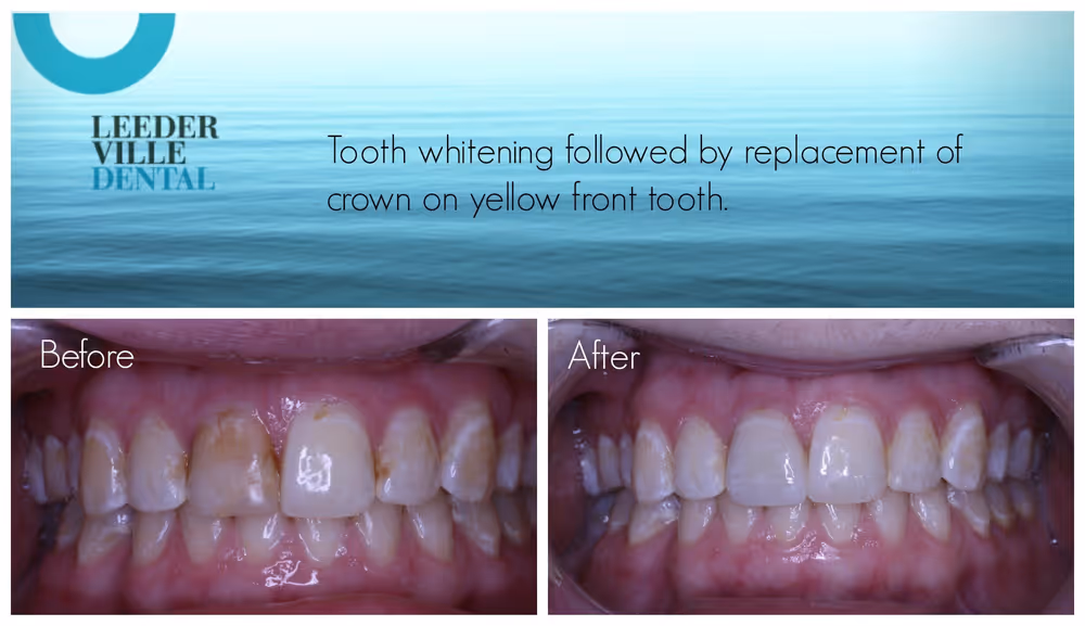 tooth whitening followed by replacement of yellow front tooth crown