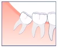 crowding caused by wisdom teeth