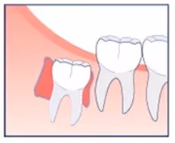 cyst around wisdom tooth