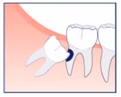 erosion cavities