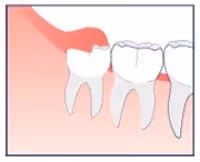 infection caused by wisdom teeth