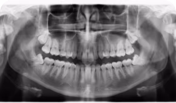 Wisdom Teeth Removal Mt Hawthorn